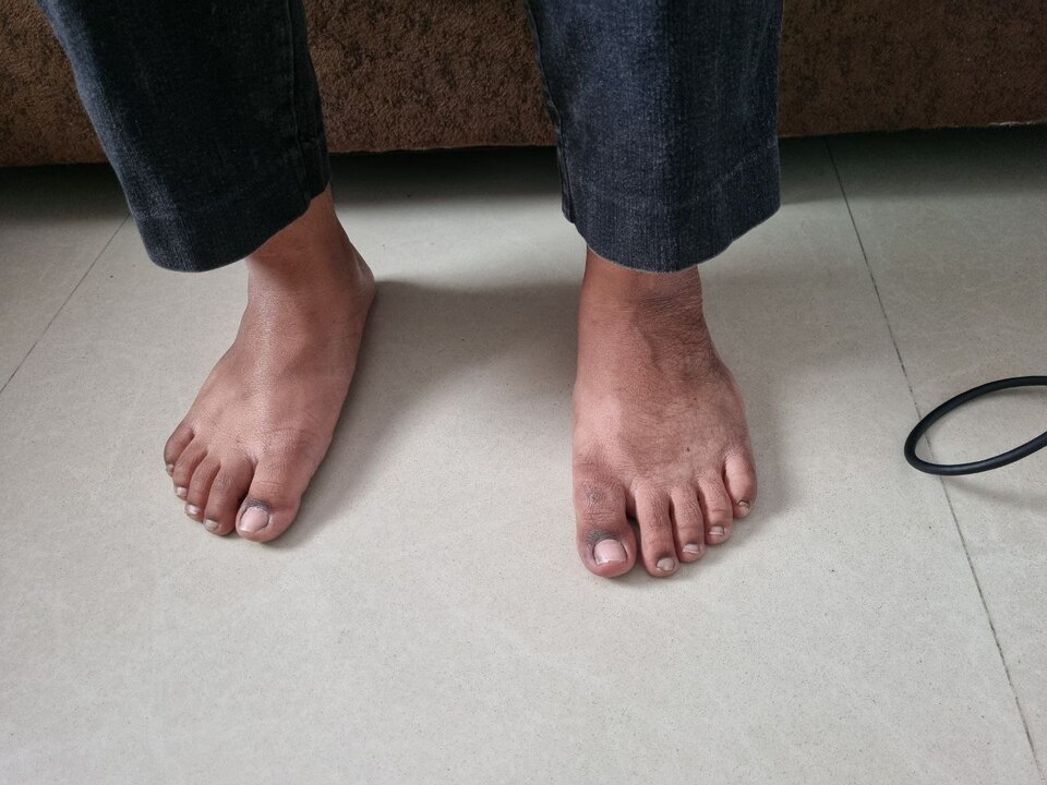Flat Foot